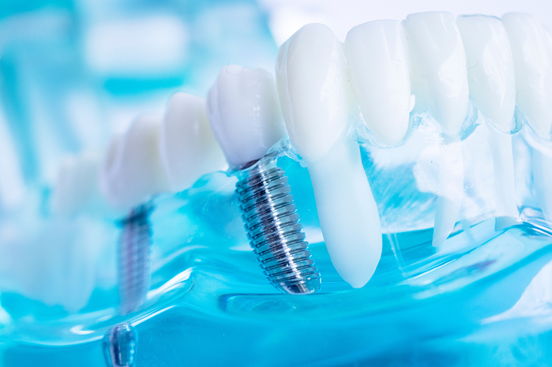 Grand View Dental Clinic | Full Mouth Reconstruction, All-on-6 and Emergency Treatment